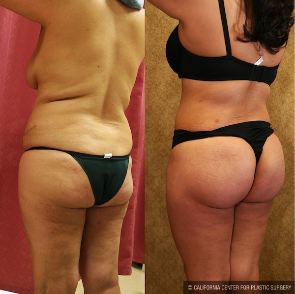 Buttock Lift/Augmentation Before & After Patient #11966