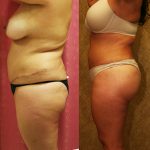 Buttock Lift/Augmentation Before & After Patient #11966