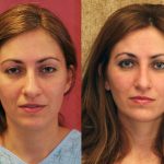 Neck & Face Liposuction Before & After Patient #12026