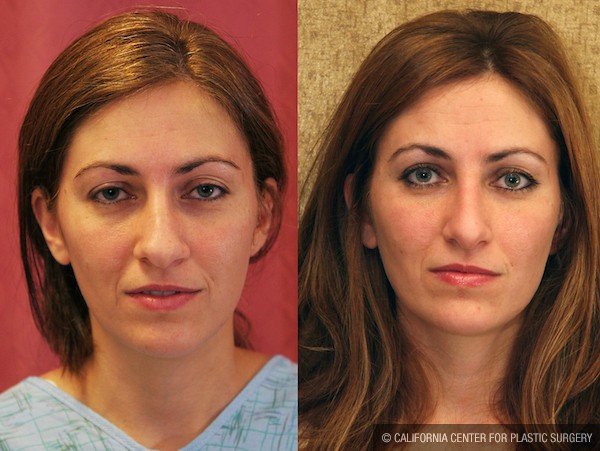 Neck & Face Liposuction Before & After Patient #12026