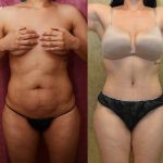 Tummy Tuck (Abdominoplasty) Small Size Before & After Patient #12071