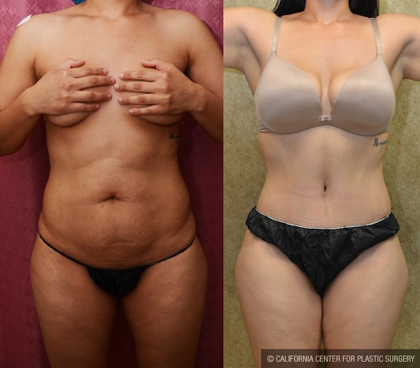 Tummy Tuck (Abdominoplasty) Small Size Before & After Patient #12071