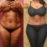 African American Tummy Tuck (Abdominoplasty) Before & After Patient #12035