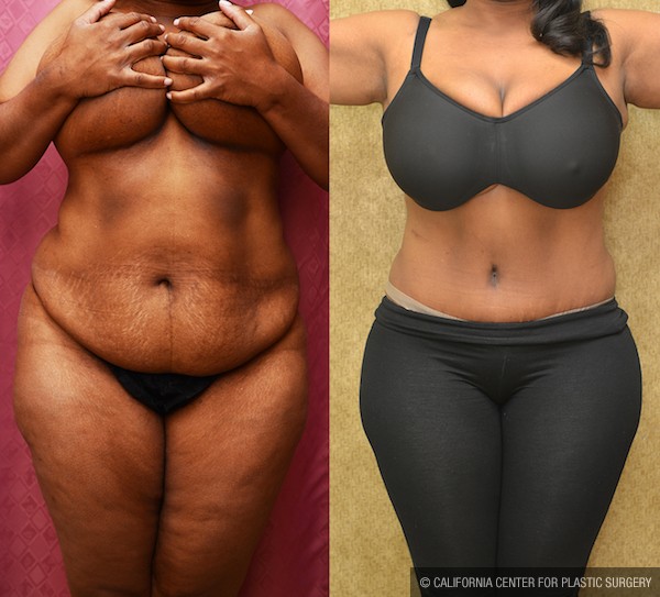 African American Tummy Tuck (Abdominoplasty) Before & After Patient #12035