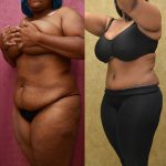 African American Tummy Tuck (Abdominoplasty) Before & After Patient #12035