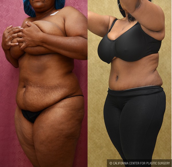 African American Tummy Tuck (Abdominoplasty) Before & After Patient #12035