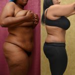 African American Tummy Tuck (Abdominoplasty) Before & After Patient #12035