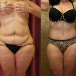 Tummy Tuck (Abdominoplasty) Medium Size Before & After Patient #12047