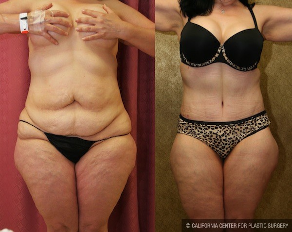Tummy Tuck Medium Size Before & After Patient #12047