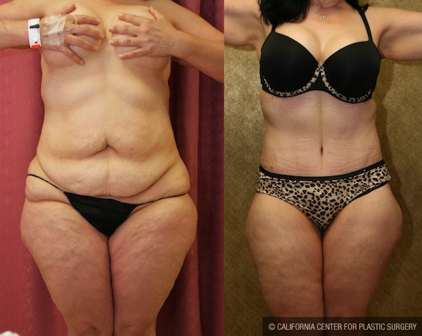 Tummy Tuck (Abdominoplasty) Medium Size Before & After Patient #12047