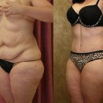 Tummy Tuck (Abdominoplasty) Medium Size Before & After Patient #12047