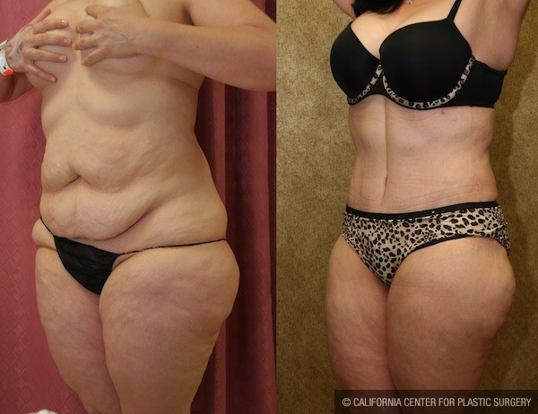 Tummy Tuck (Abdominoplasty) Medium Size Before & After Patient #12047