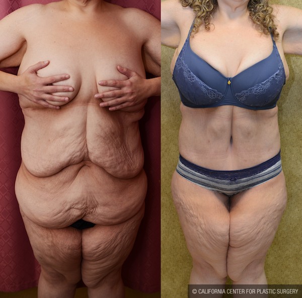 Tummy Tuck Plus Size Before & After Patient #12055