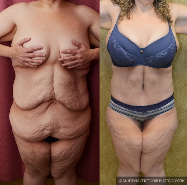 Tummy Tuck (Abdominoplasty) Plus Size Before & After Patient #12055