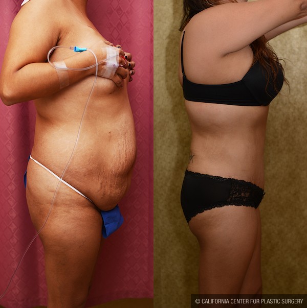 Tummy Tuck (Abdominoplasty) Plus Size Before & After Patient #12059