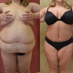 Tummy Tuck (Abdominoplasty) Plus Size Before & After Patient #12067