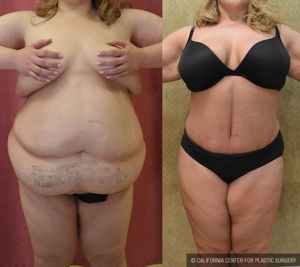 Tummy Tuck (Abdominoplasty) Plus Size Before & After Patient #12067