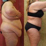 Tummy Tuck (Abdominoplasty) Plus Size Before & After Patient #12067