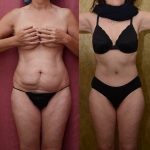 Tummy Tuck (Abdominoplasty) Small Size Before & After Patient #12080