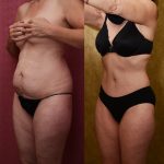 Tummy Tuck (Abdominoplasty) Small Size Before & After Patient #12080