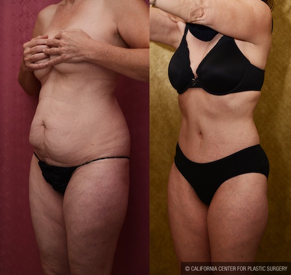 Tummy Tuck (Abdominoplasty) Small Size Before & After Patient #12080