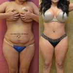 Tummy Tuck (Abdominoplasty) Small Size Before & After Patient #12084