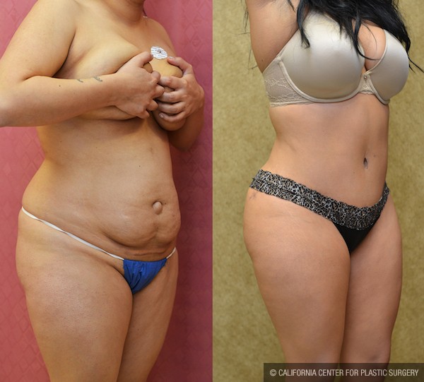 Tummy Tuck (Abdominoplasty) Small Size Before & After Patient #12084