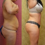 Tummy Tuck (Abdominoplasty) Small Size Before & After Patient #12084