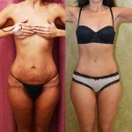 Tummy Tuck (Abdominoplasty) Small Size Before & After Patient #12088