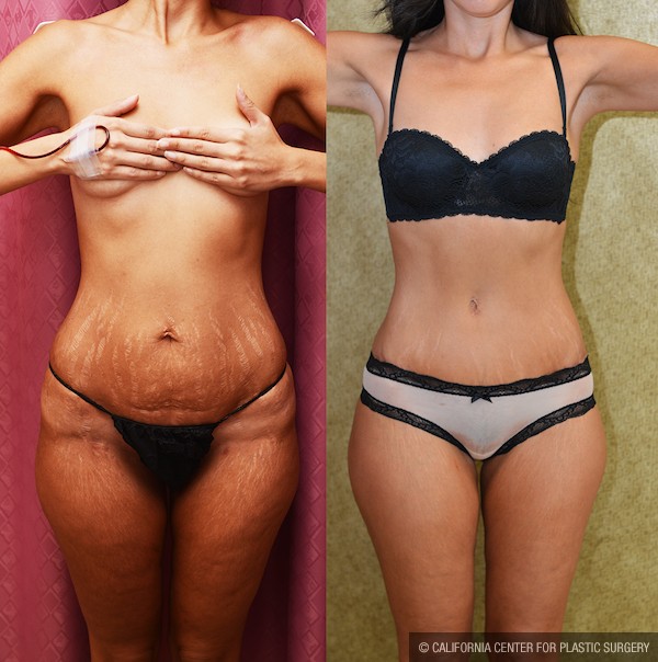 Tummy Tuck (Abdominoplasty) Small Size Before & After Patient #12088