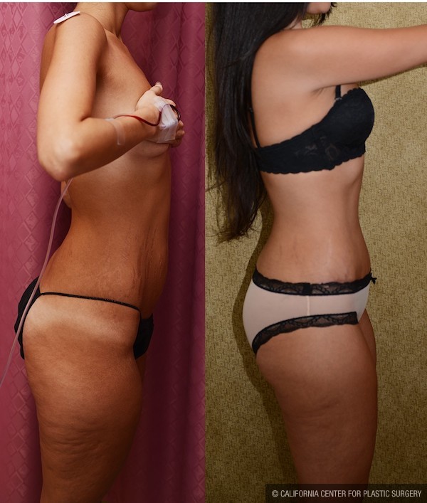 Tummy Tuck (Abdominoplasty) Small Size Before & After Patient #12088