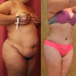Tummy Tuck (Abdominoplasty) Plus Size Before & After Patient #12063
