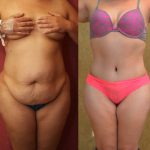 Tummy Tuck (Abdominoplasty) Plus Size Before & After Patient #12063