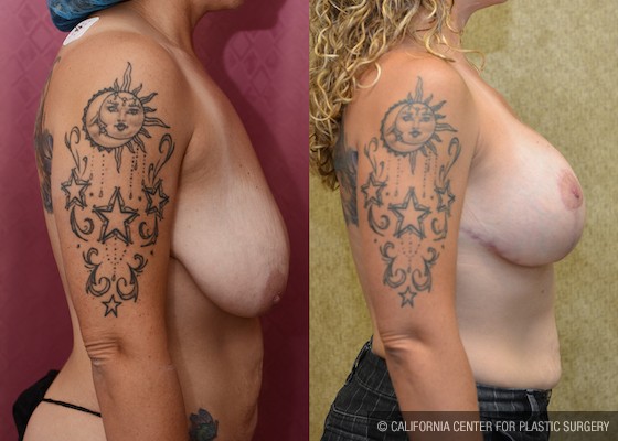 Breast Lift - Full Before & After Patient #11952