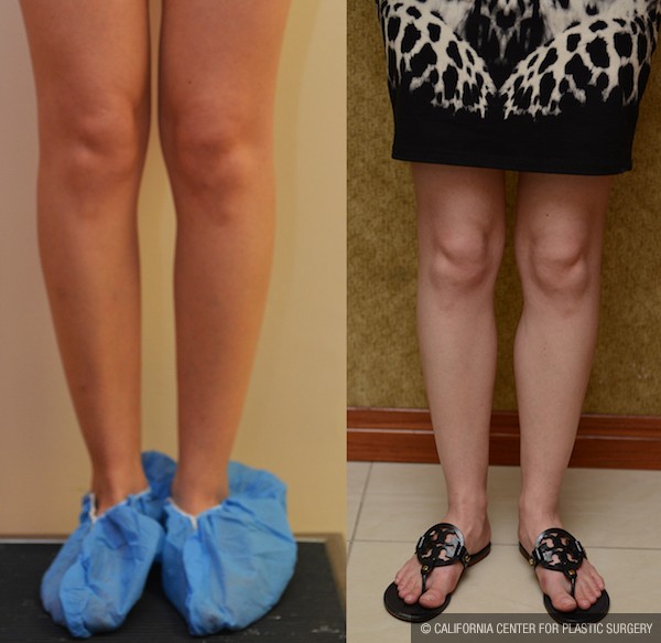 Calf Augmentation Before & After Patient #11970