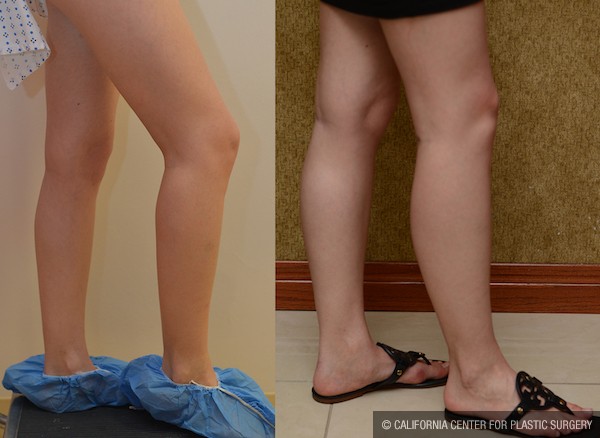 Calf Augmentation Before & After Patient #11970