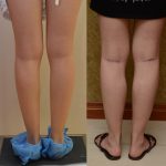 Calf Augmentation Before & After Patient #11970