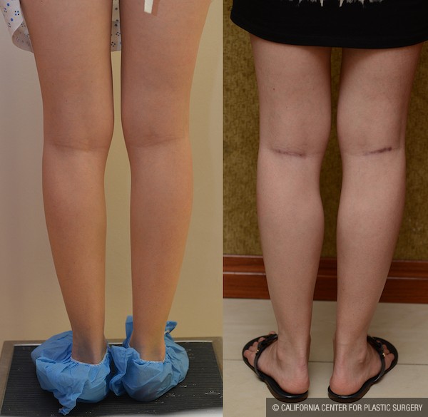 Calf Augmentation Before & After Patient #11970