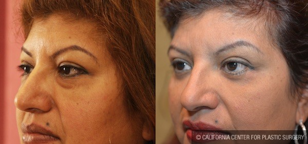 Eyelid (Blepharoplasty) Before & After Patient #11974