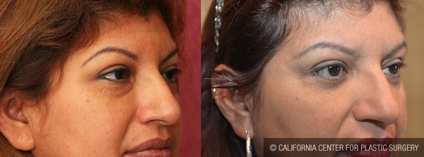 Eyelid (Blepharoplasty) Before & After Patient #11974