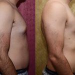 Male gynecomastia (breast) reduction Before & After Patient #11984