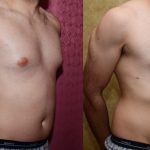 Male gynecomastia (breast) reduction Before & After Patient #11984