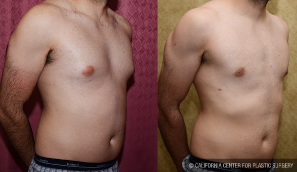 Male gynecomastia (breast) reduction Before & After Patient #11984