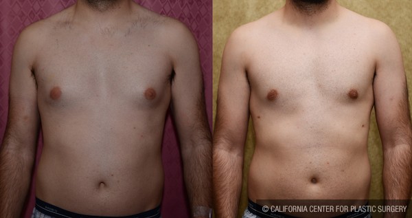 Male gynecomastia (breast) reduction Before & After Patient #11984