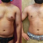 Male gynecomastia (breast) reduction Before & After Patient #11988