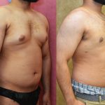 Male gynecomastia (breast) reduction Before & After Patient #11988