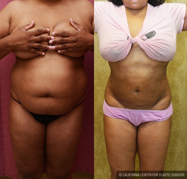 Liposuction Abdomen Medium Before & After Patient #11992