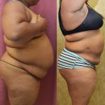 Liposuction Abdomen Plus Size Before & After Patient #12008