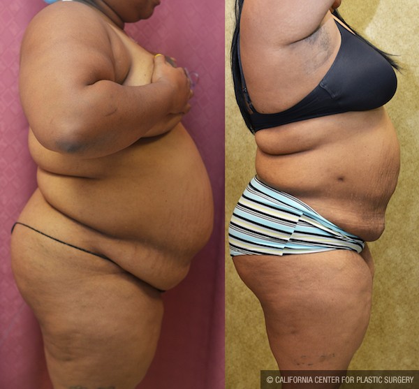 Liposuction Abdomen Plus Size Before & After Patient #12008