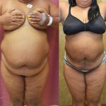 Liposuction Abdomen Plus Size Before & After Patient #12008